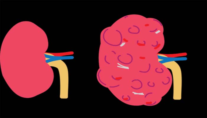 Gagal Organ Bisa Jadi Komplikasi Penyakit Ginjal Polikistik